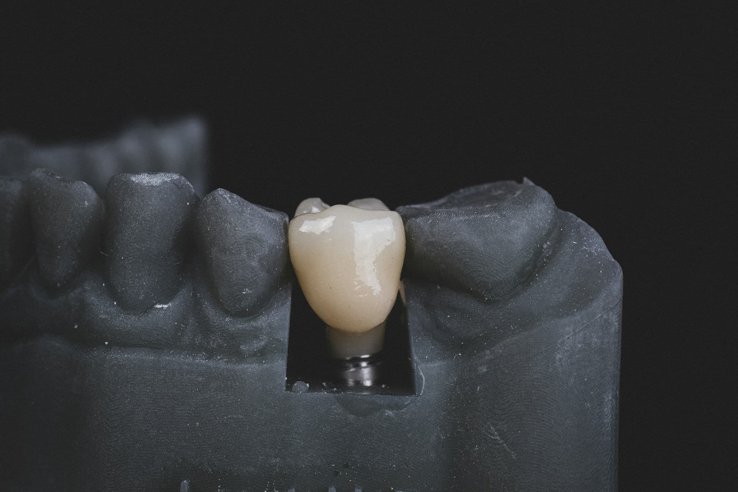 Single Tooth Implants